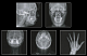 3D томограф GENORAY Volux 55 16×14 без цефалостата